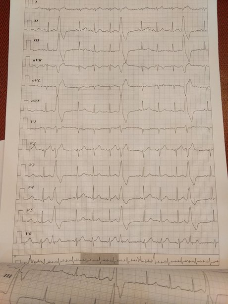 完全性右束支传导阻滞 窦性心律 房性早搏 窦性心动过缓 窦性心律心电