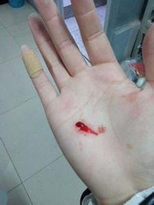 相关搜索 受伤的手指 大拇指受伤 手指往下 手指受伤 手指受伤流血