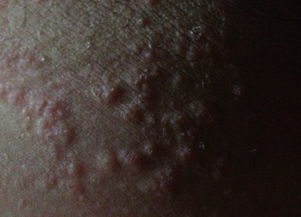 大腿内侧红 疙瘩痒 斗图表情包大全   与  大腿内