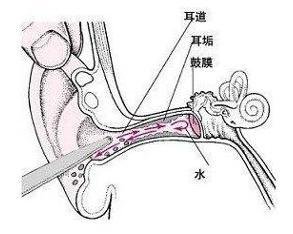 外耳道耵聍图 斗图表情包大全   与  外耳道耵聍