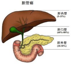 胆管癌