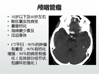 颅咽管瘤