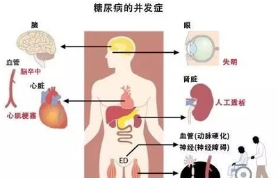 糖尿病
