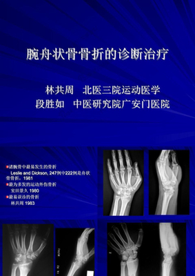 右手舟骨骨折能评几级伤残