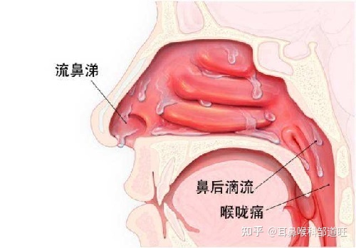 喉咙炎症怎么治疗