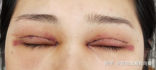 做梦割双眼皮什么意思