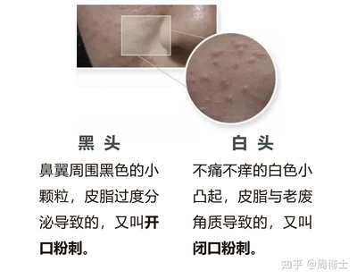 鼻底长痘痘怎麼辦