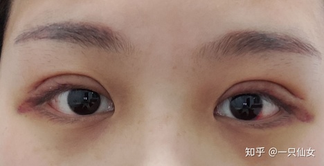 做完双眼皮有淤血怎么办