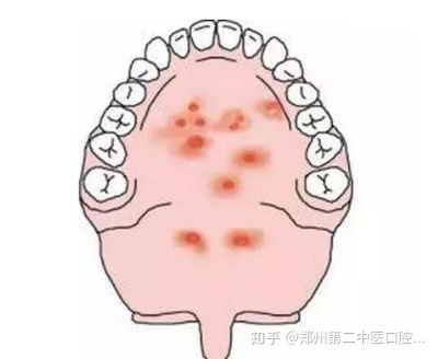 宝宝口腔疱疹怎么治疗