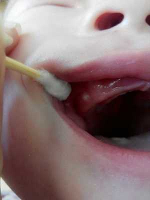 痘痘是疮吗