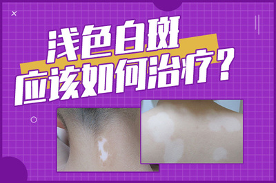 白癜风该怎么治疗好