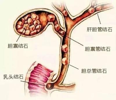 胆管结石怎么治疗好
