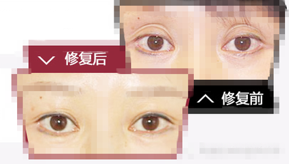 下眼皮凹陷修复哪里好