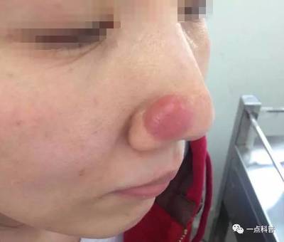 鼻子上痘痘用什么药膏