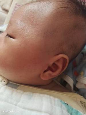 小孩脸上长小红点是怎么回事