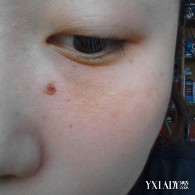点痣几天结痂