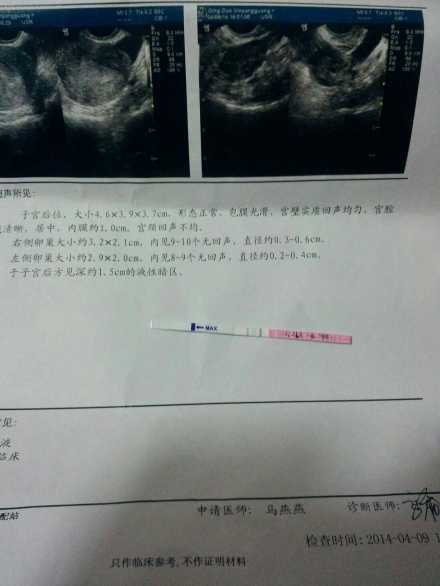 无优势卵泡竟然怀孕了