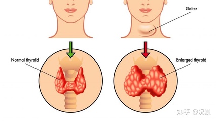 甲状腺有炎症怎么治疗