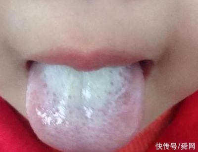 舌苔白厚腻是怎么回事