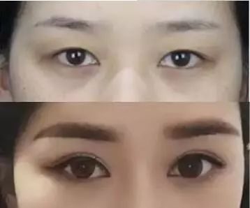 双眼皮切口处发红