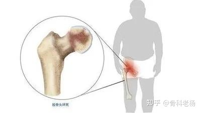 怀孕股骨头疼怎么回事