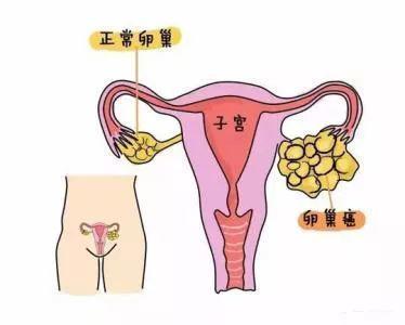 卵巢囊肿怀孕