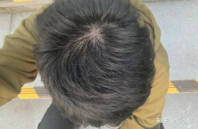 男生爱掉头发是怎么回事