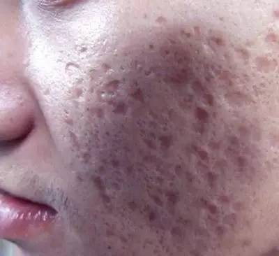 暗疮痘痘怎么治疗方法