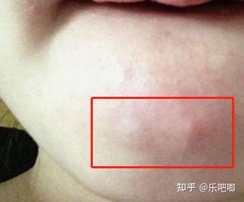 下巴上起痘痘用啥