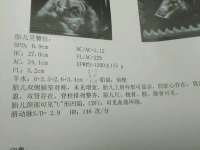 胎儿fl标准对照表