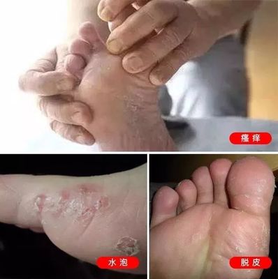 脚蜕皮是怎么回事