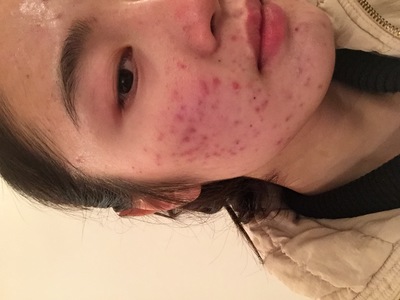 去美容院针清痘痘好吗