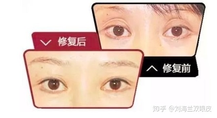 下眼皮凹陷修复哪里好