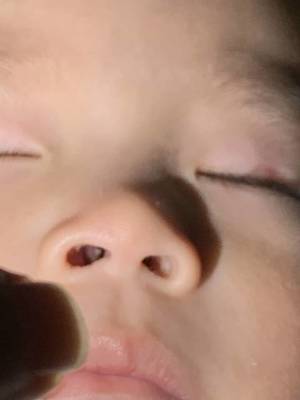 鼻子侧面长了个痘痘