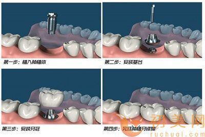 带牙套好还是烤瓷牙好