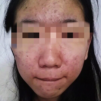 怎么根治痘痘的方法