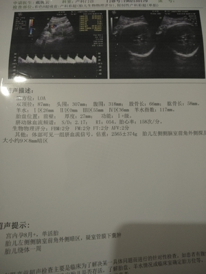 侧脑室宽说明胎儿聪明