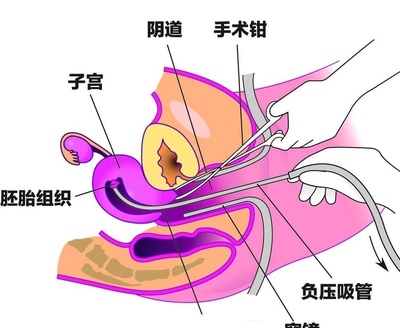 人流一次还能怀孕吗