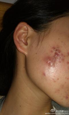 脓包型痤疮怎么治疗