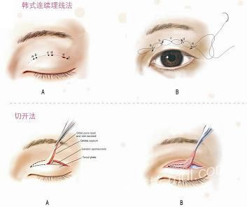 埋线双眼皮的好处