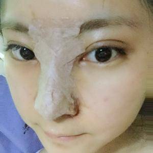 隆鼻打几天消炎针