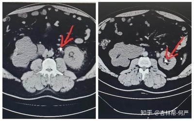 双肾结石怎么治疗好