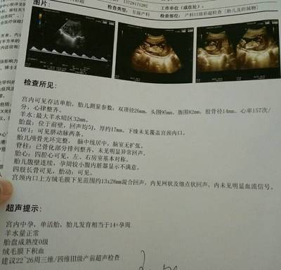胎盘在右侧壁胎儿图片