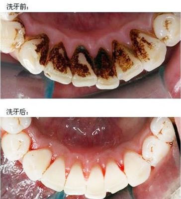 洗牙怎么样