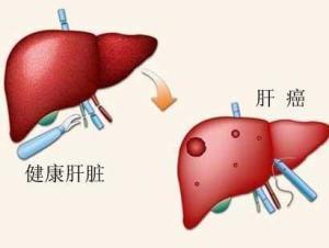 肝脏疾病