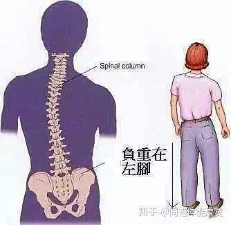 老人脊柱侧弯怎么治疗