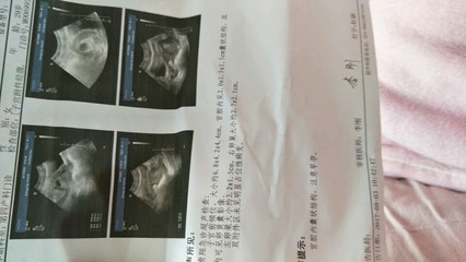 怀孕45天有什么症状