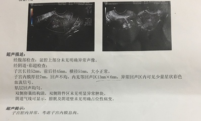 内膜息肉会影响怀孕吗