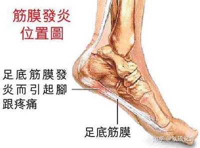 足底筋膜炎怎么治疗