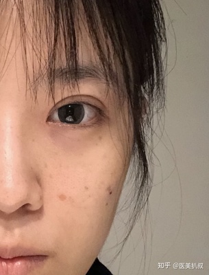 双眼皮一会有一会没有